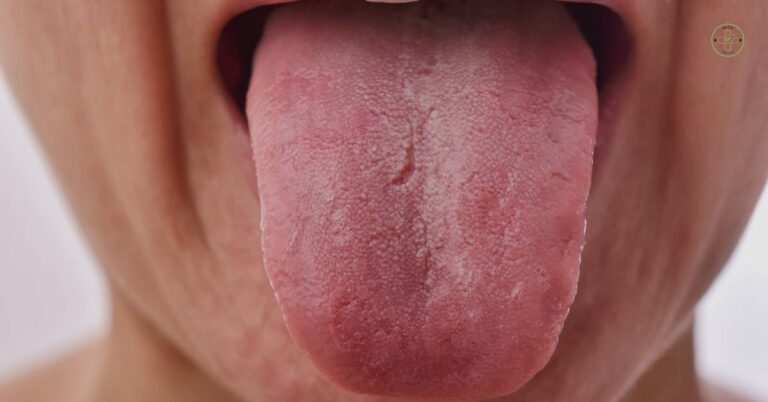Máte Bolest Jazyka? 7 Zaručených Tipů Jak Co Vám Pomohou! 1 a swollen tongue with visible redness and a rough texture, potentially indicative of tongue irritation or inflammation causing pálení jazyka