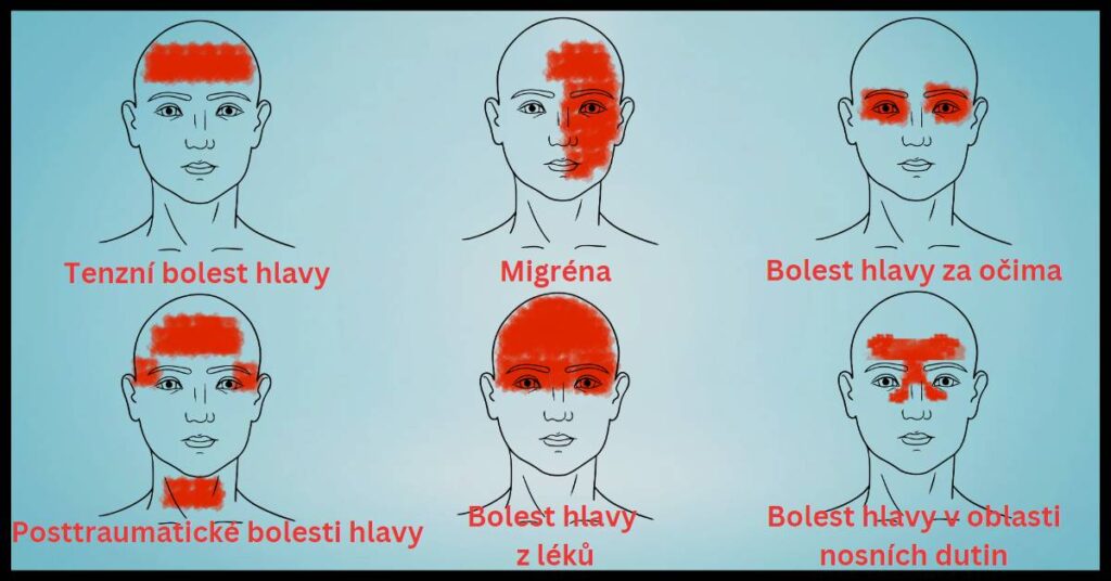 mapa bolesti hlavy s 6 hlavními typy bolestí hlavy