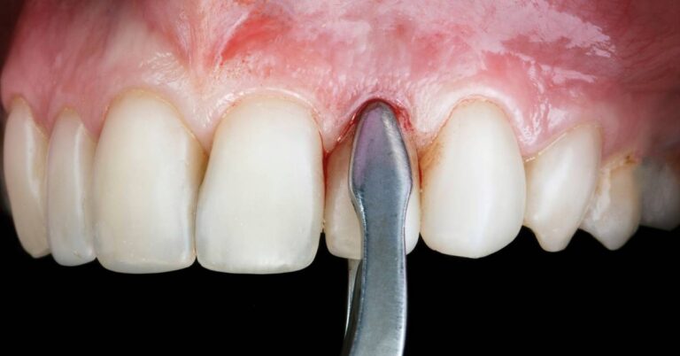 a close-up of dental alveolitida showing exposed dry socket with a dental tool pointing at inflamed gum tissue post-tooth extraction