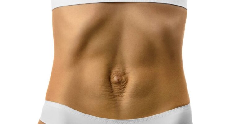 a person demonstrating postnatální diastáza břišních svalů with visible separation near the belly button.